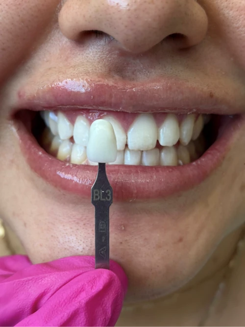 Después del tratamiento de Denisse